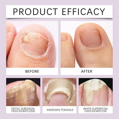 Nail Treatment Solution Serum (15ml) (Pack of 2)