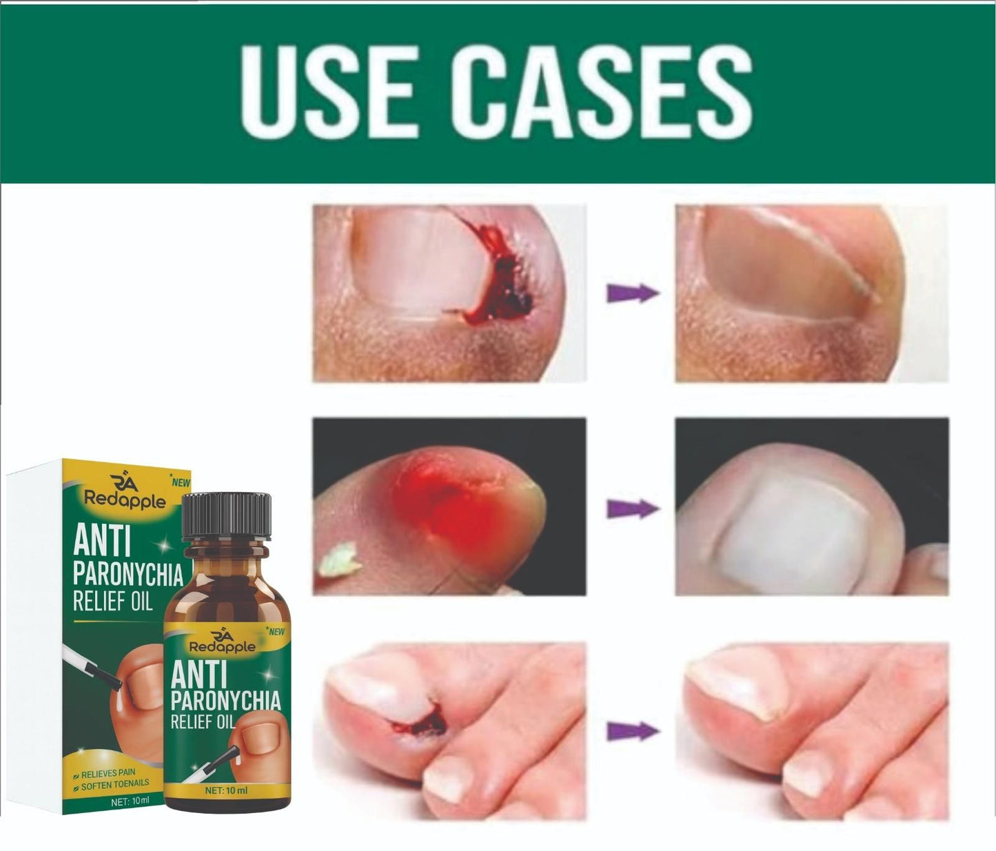 Nails repair & Anti Paronychia Relief Oil 20 ml Pack of 2