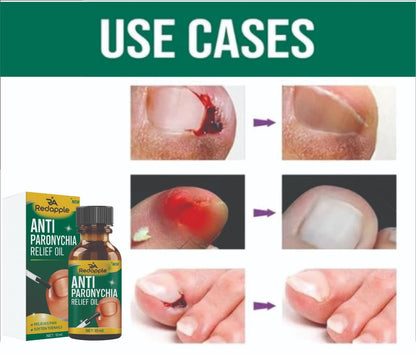 Nails repair & Anti Paronychia Relief Oil 20 ml Pack of 2